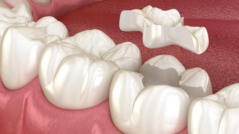 Những điều cần biết về trám răng inlays 1