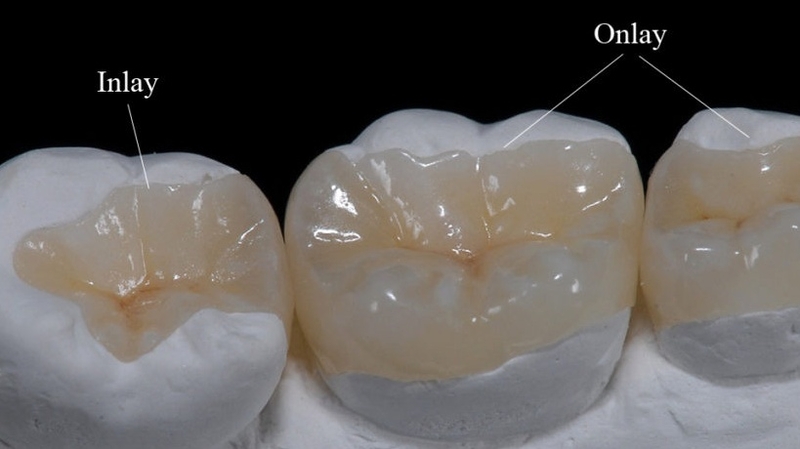 Những điều cần biết về trám răng inlays 2