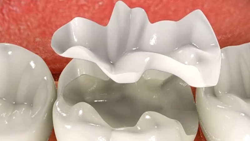 Những điều cần biết về trám răng inlays 3