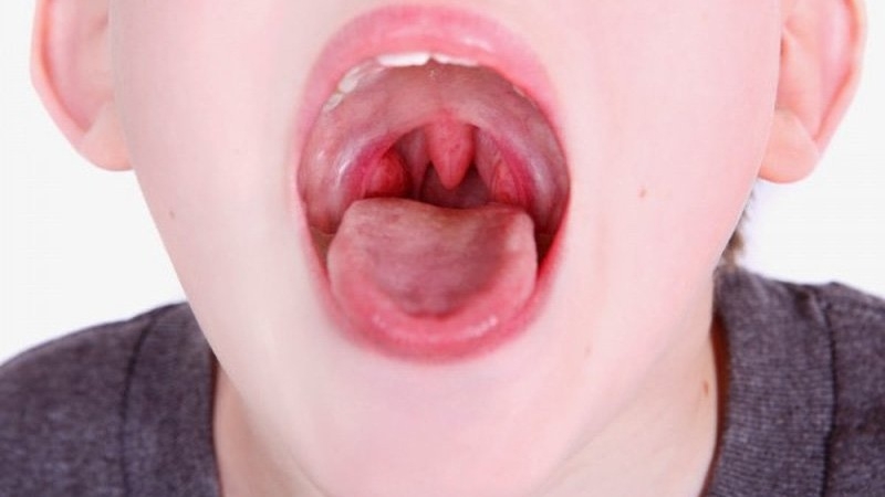 phân loại u vòm họng lành tính 2