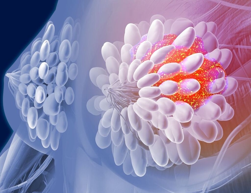 Những điều cần biết về ung thư vú và chi phí điều trị ung thư vú 1