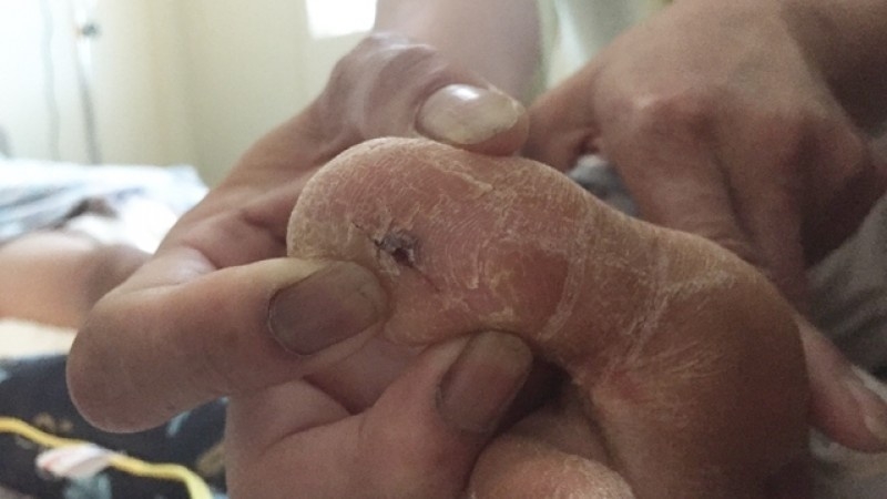 Những điều cần biết về uốn ván bệnh học