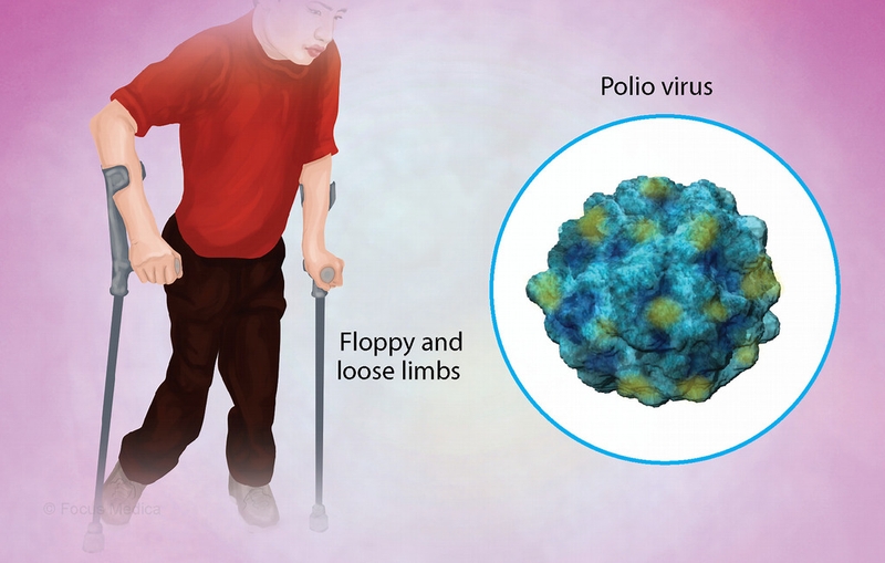 Những điều cần biết về việc sử dụng vắc-xin bại liệt dạng uống và tiêm 1