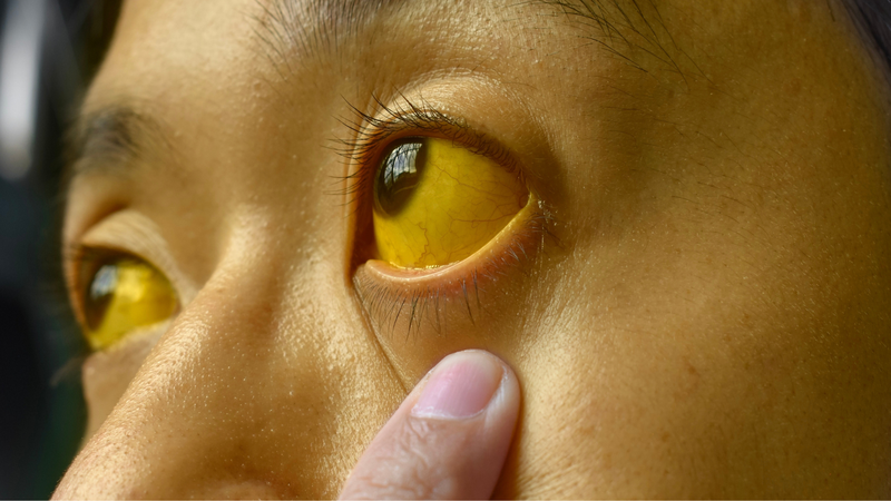 Vàng da là dấu hiệu điển hình giúp nhận biết viêm gan B