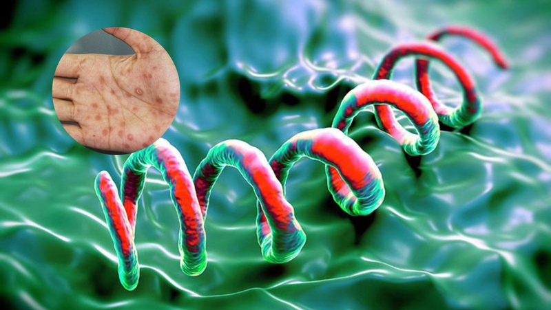 Những điều cần biết về xét nghiệm Syphilis ab và bệnh giang mai 1