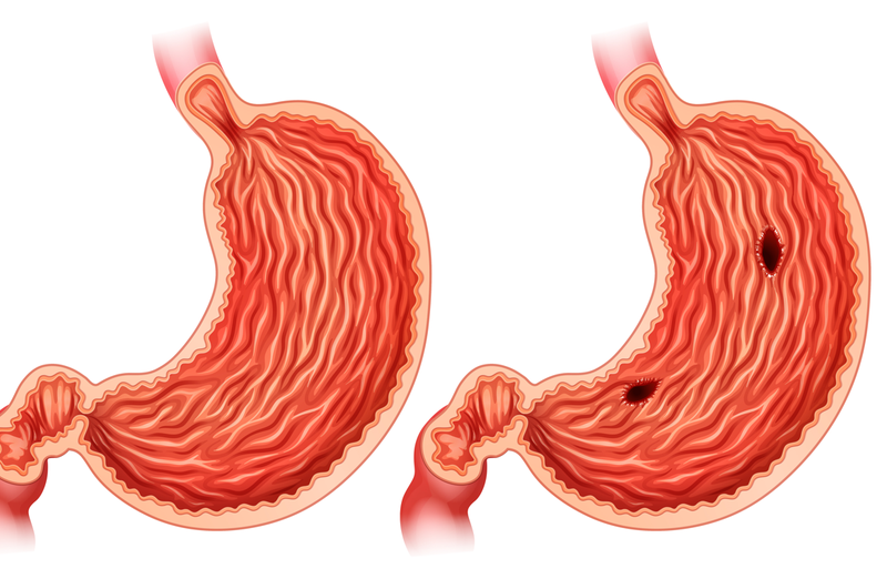 Những điều cần biết về xuất huyết dạ dày ở trẻ em 1