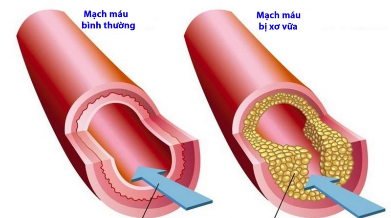 Những điều nên biết về suy giảm tuần hoàn máu 3