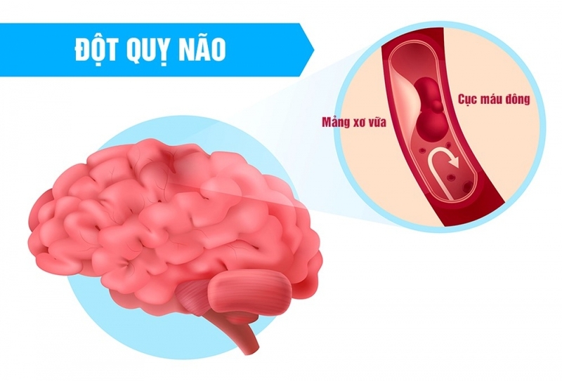 Những điều nên biết về suy giảm tuần hoàn máu 4