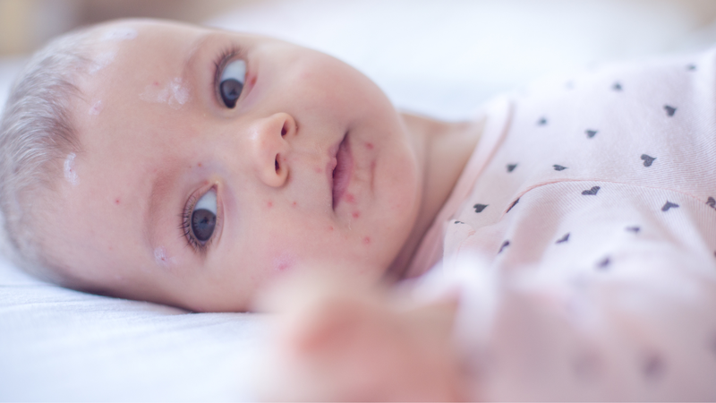 Những điều nên biết về thủy đậu sau sinh 2