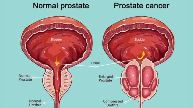 Những điều nên biết về xạ trị ung thư tuyến tiền liệt 1
