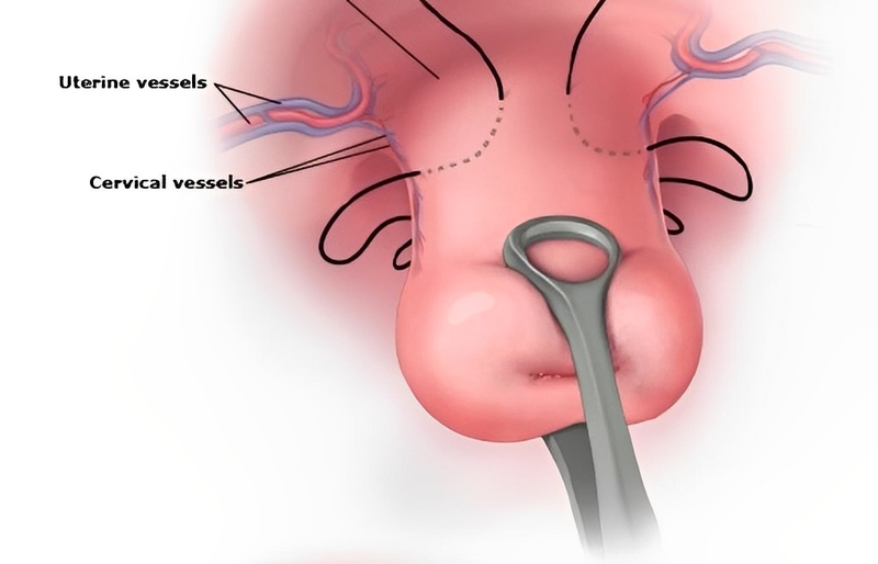 Những điều quan trọng thai phụ cần biết về khâu vòng cổ tử cung 3