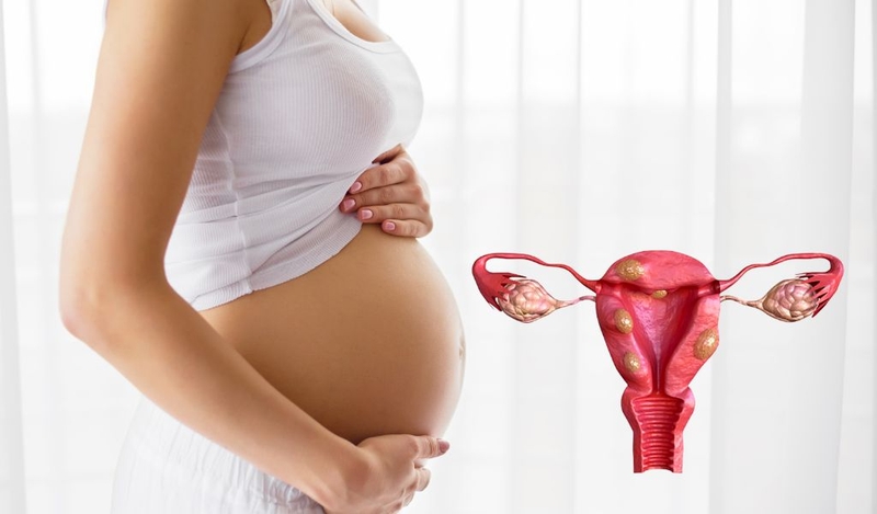 Những đối tượng dễ bị u xơ tử cung giai đoạn 4 và phương pháp điều trị? 2