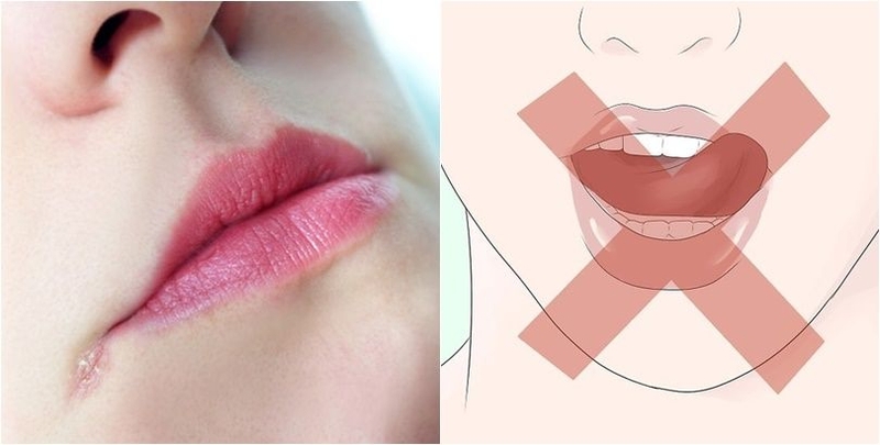 Những giải pháp phòng chống bệnh chốc mép cho trẻ khi thời tiết hanh khô