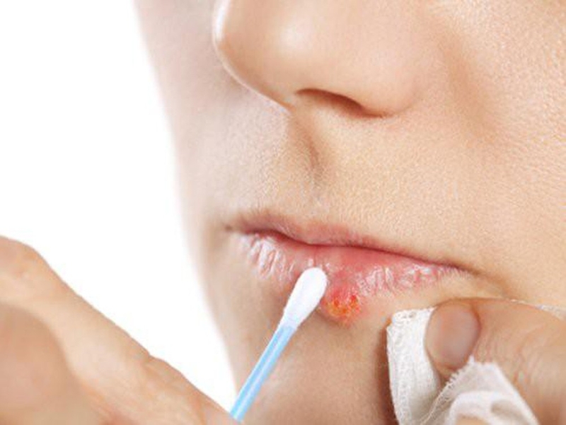 Những giải pháp phòng chống bệnh chốc mép cho trẻ khi thời tiết hanh khô