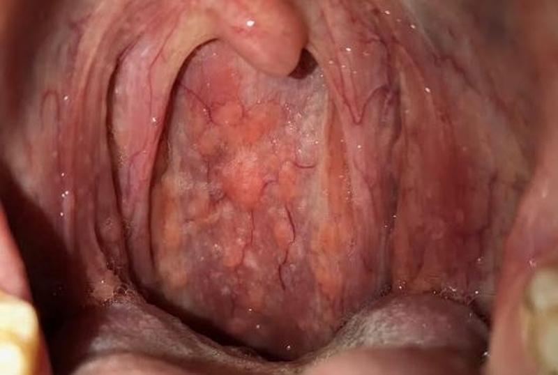 Những hình ảnh bị viêm họng hạt khiến nhiều người phải giật mình 3