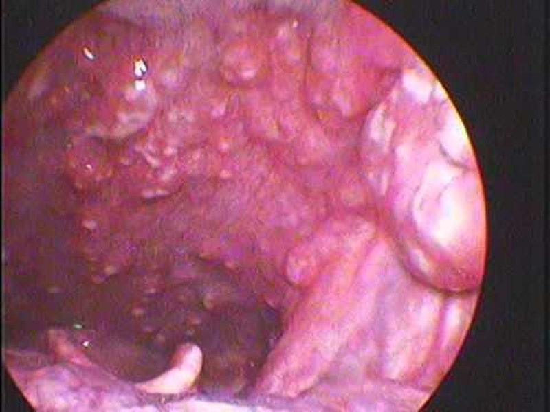 Những hình ảnh bị viêm họng hạt khiến nhiều người phải giật mình 4