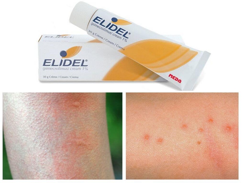 Những loại thuốc điều trị viêm da tiếp xúc dị ứng bạn cần biết 3