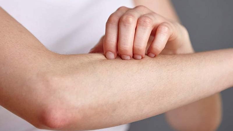 Dị ứng, nổi mẩn ngứa là một trong những tác dụng phụ của hoạt huyết