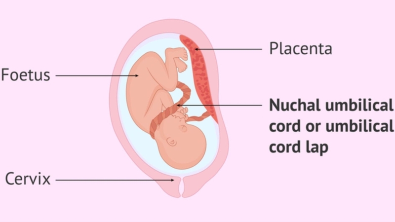 Hầu hết các trường hợp dây rốn quấn cổ 1 vòng đều không đáng lo ngại