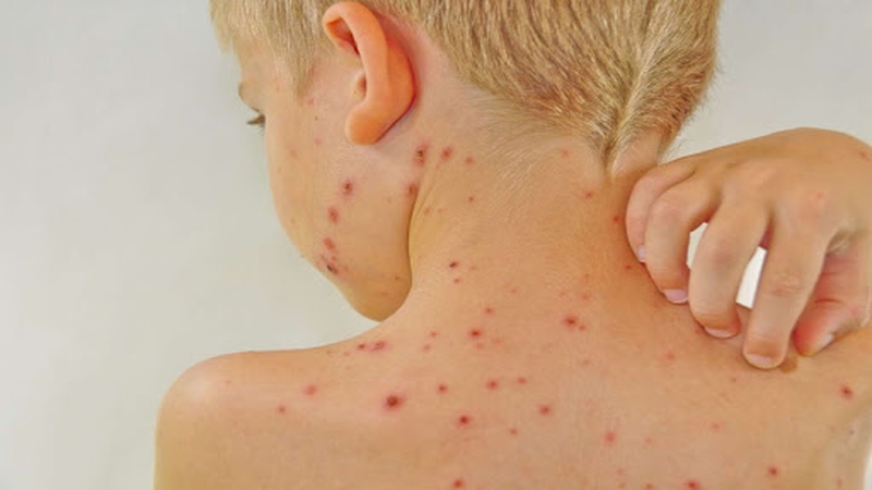 Những mẹo dân gian chữa sốt phát ban an toàn cho trẻ tại nhà 1