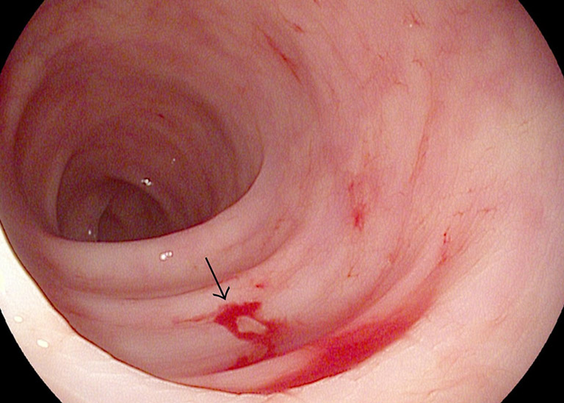 Có thể bạn chưa biết: Những người nào không nên ăn quả sung? 2