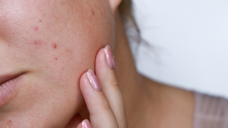 Người nóng trong, dễ nổi mụn là một trong những người không nên ăn sầu riêng