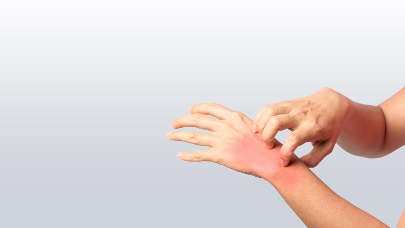 Dị ứng là tác dụng phụ phổ biến nhất khi dùng sữa ong chúa không đúng đối tượng