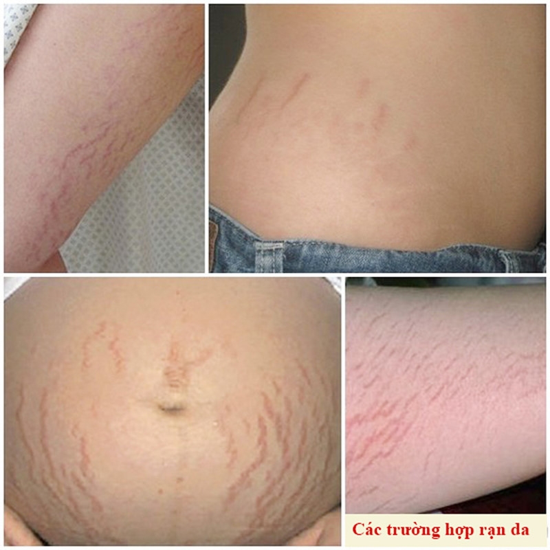 nhung-nguyen-nhan-khien-ban-bi-ran-da-va-cach-phong-tranh