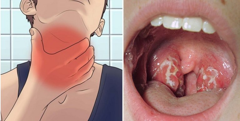 Những nguyên nhân khiến con bị viêm amidan