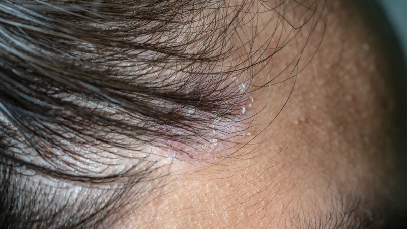 Những nguyên nhân rụng tóc ở nữ có thể bạn chưa biết 4