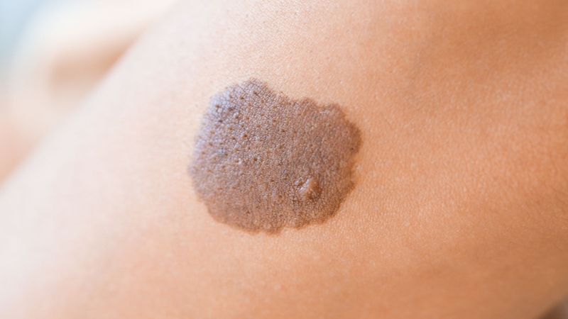 Những nguyên nhân ung thư da hàng đầu bạn cần biết để phòng ngừ 4