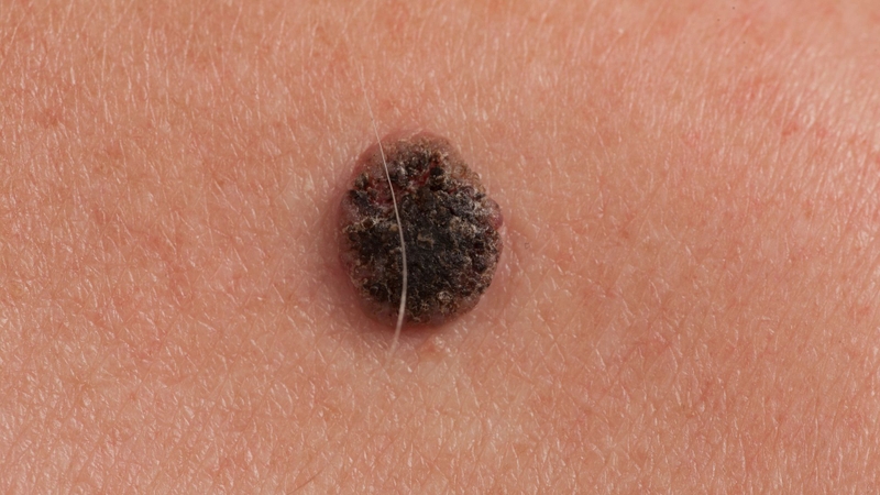 Những nguyên nhân ung thư da hàng đầu bạn cần biết để phòng ngừ 1