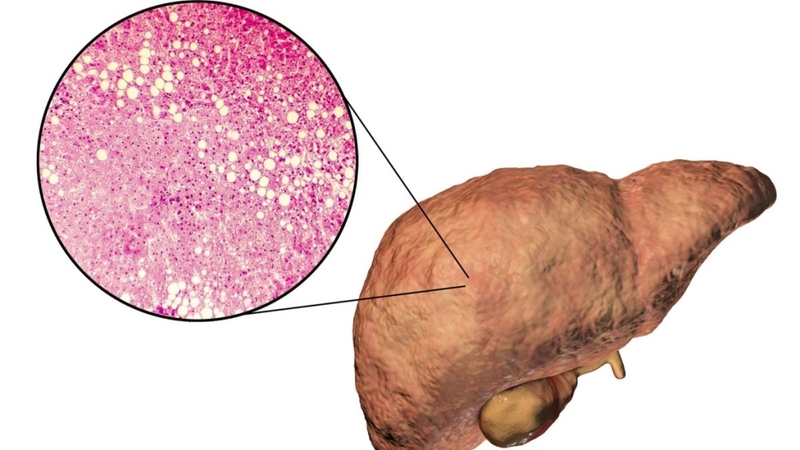 Những nguyên nhân ung thư gan hàng đầu: Tìm hiểu để phòng ngừa hiệu quả 2