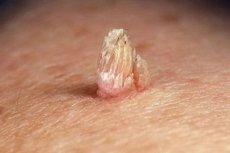 Những phương pháp điều trị bệnh sùi mào gà 1