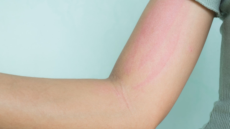 Ung thư da là rủi ro nghiêm trọng nhưng thường bị xem nhẹ vì hậu quả xuất hiện chậm