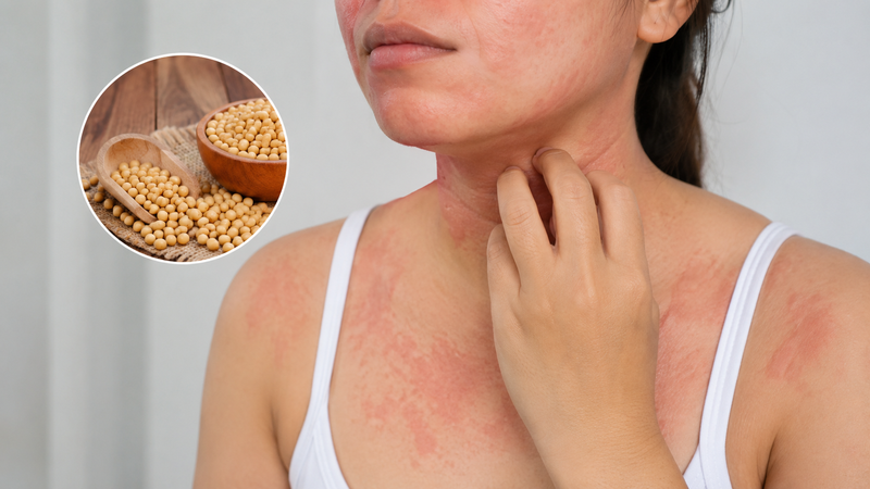 Dị ứng đậu nành có thể gây ngứa, nổi mề đay, phát ban