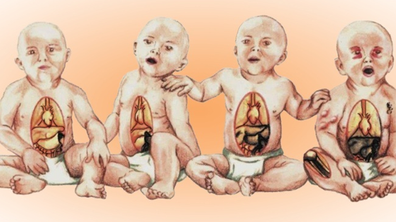 U nguyên bào thần kinh ở trẻ em