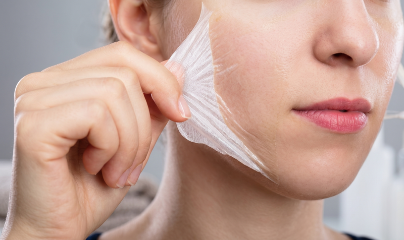 Có nên nặn mụn sau khi peel da không thì câu trả lời là không