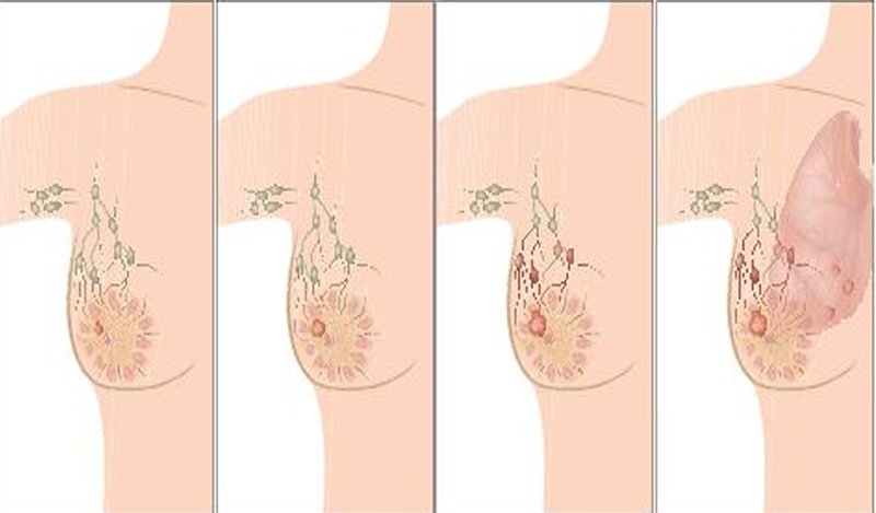 Xuất hiện khối u cứng bất thường