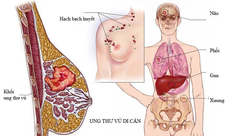 Di căn ưng thư vú