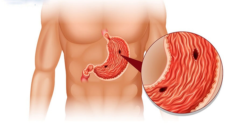 Những thói quen gây đau dạ dày nhất định phải tránh 1