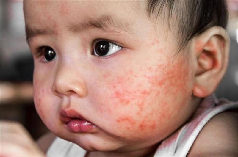 Những thông tin ba mẹ cần biết về bệnh ngoài da ở trẻ sơ sinh 2