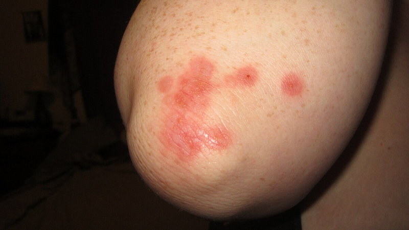 Các dấu hiệu nhỏ trên da có thể là cảnh báo của bệnh tay chân miệng ở trẻ