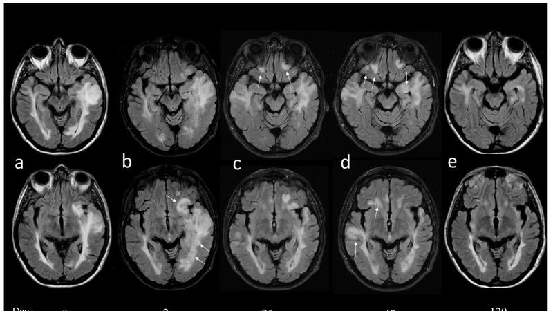 Những thông tin cần biết về bệnh xơ não tuỷ 1