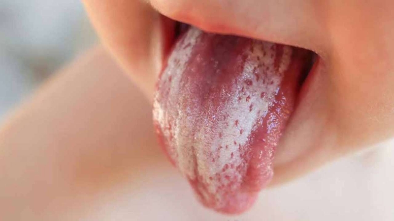 Những thông tin cần biết về căn bệnh nấm miệng dưới lưỡi ở trẻ em1