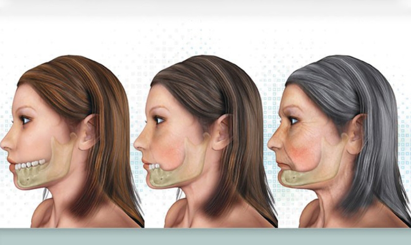 Những thông tin cần biết về kỹ thuật ghép xương răng