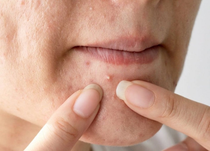 Những thông tin cần biết về tình trạng da bị mụn nang 3