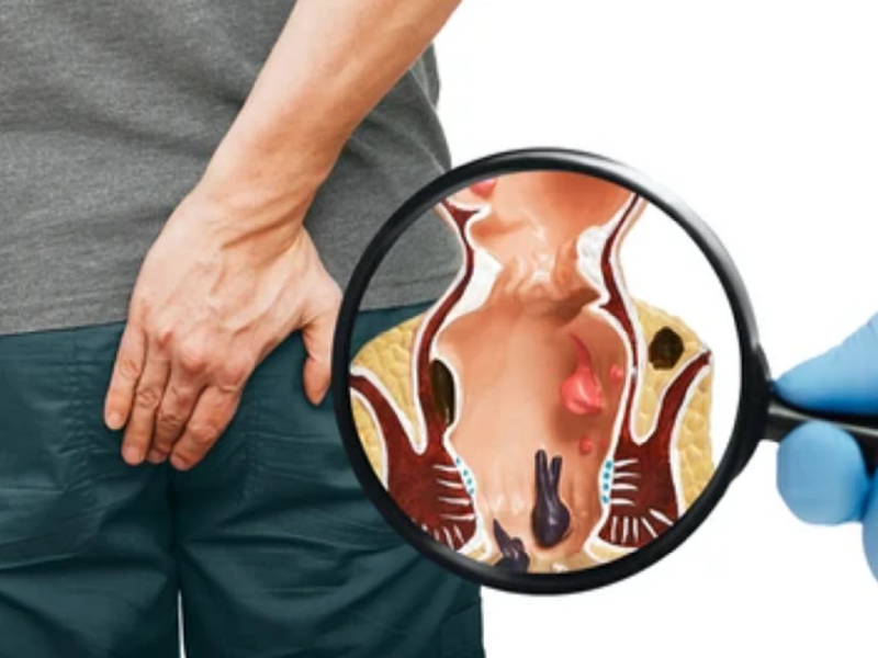 Những thông tin cần biết về trĩ ngoại độ 2-2