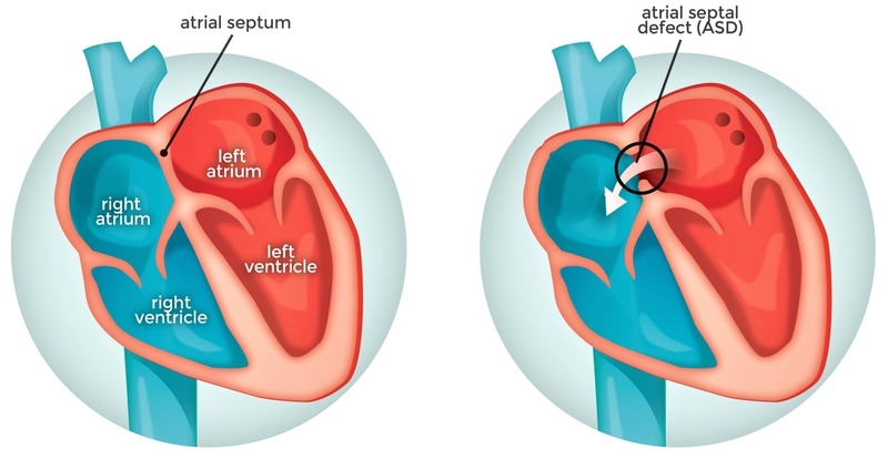 Những thông tin cần biết về vá lỗ thông liên nhĩ 2