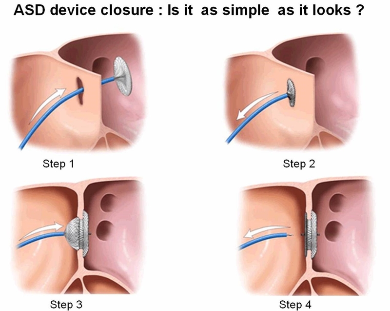 Những thông tin cần biết về vá lỗ thông liên nhĩ 3